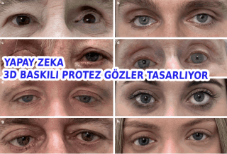 Yapay Zeka ile Tasarlanmış 3D baskılı Protez Gözler